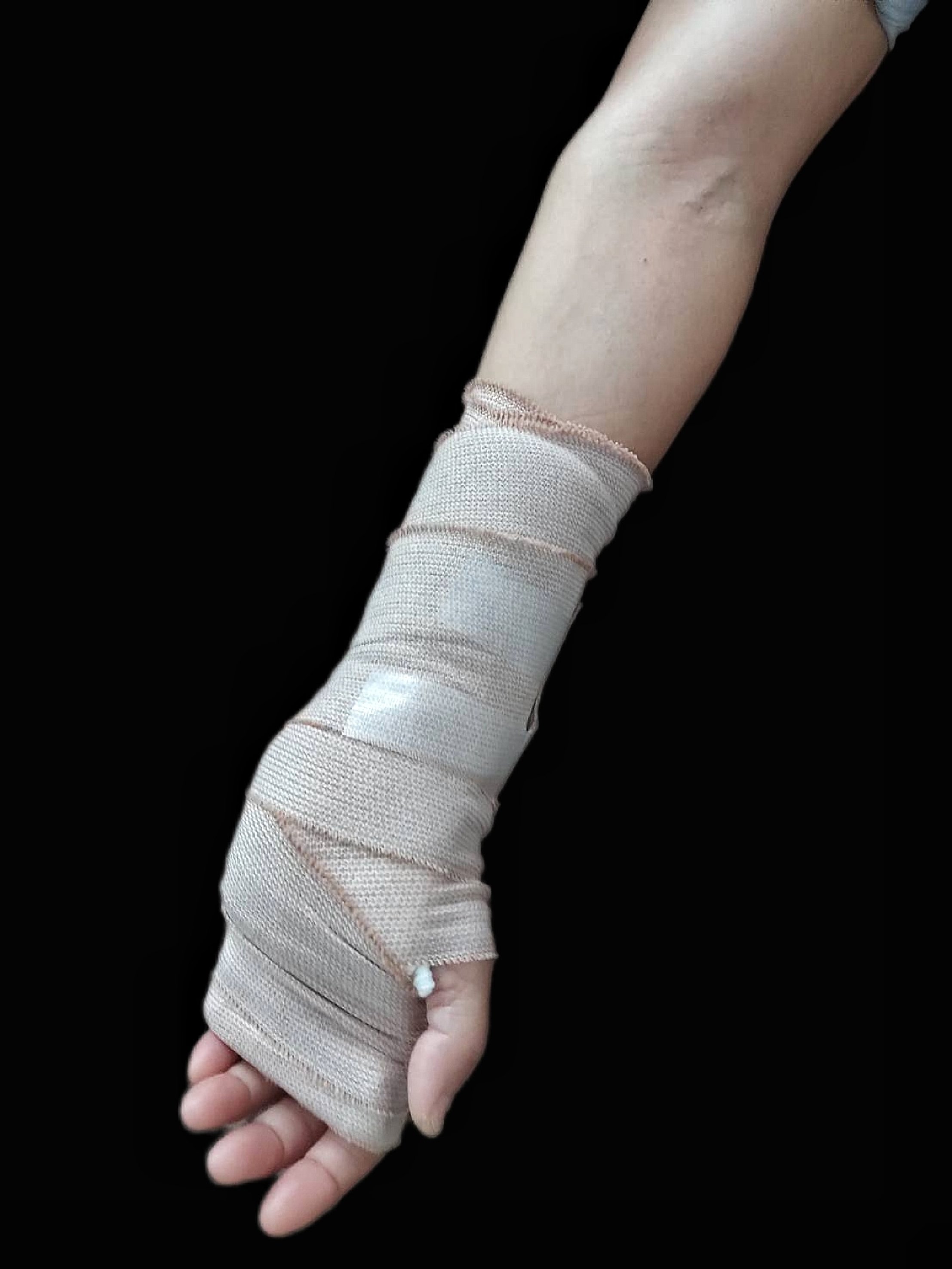 The operated hand must be splinted with a soft cast to prevent injury.