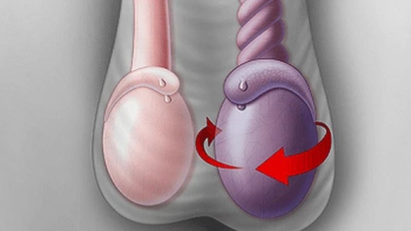 Hình ảnh minh họa bìu sưng to