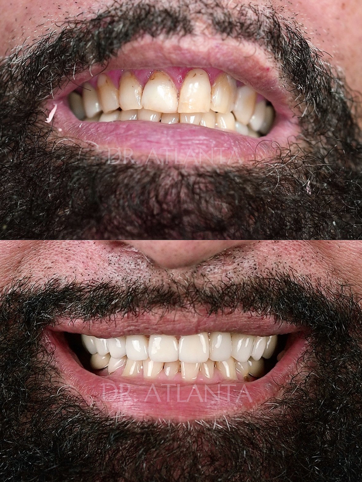 Veneer transformation before and after
