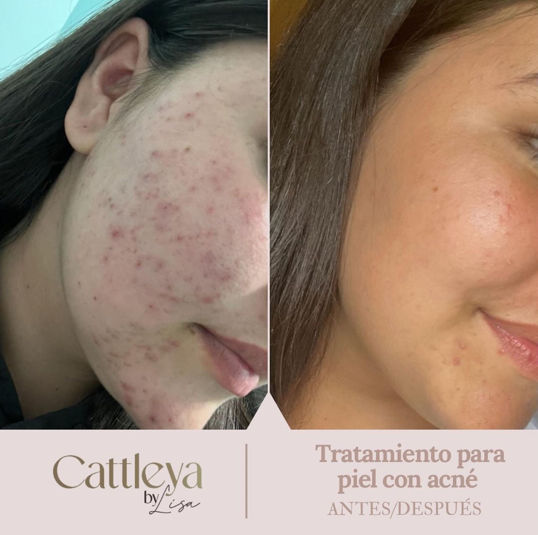 Resultados de tratamiento facial - Antes y Después