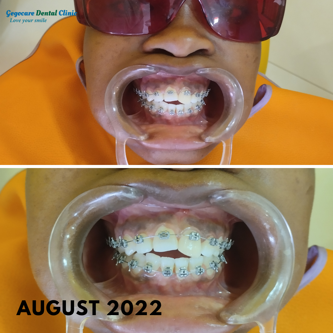 Dental braces orthodontic treatment