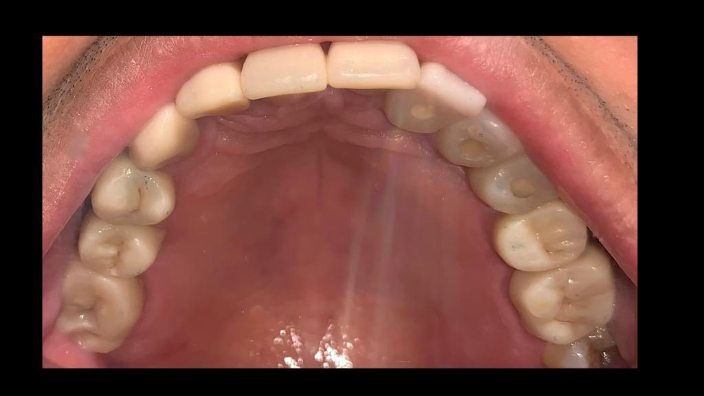 Fase 4: Resultado final de la rehabilitación oral completa