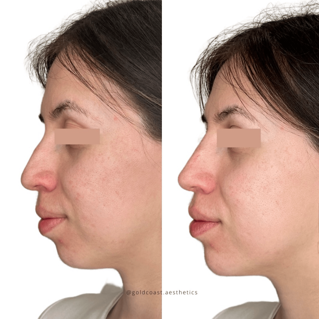 Facial balancing before and after