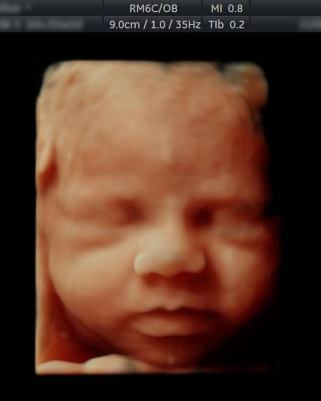 A 3D ultrasound image of a babys face, showing detailed features with eyes closed and a visible nose and mouth.
