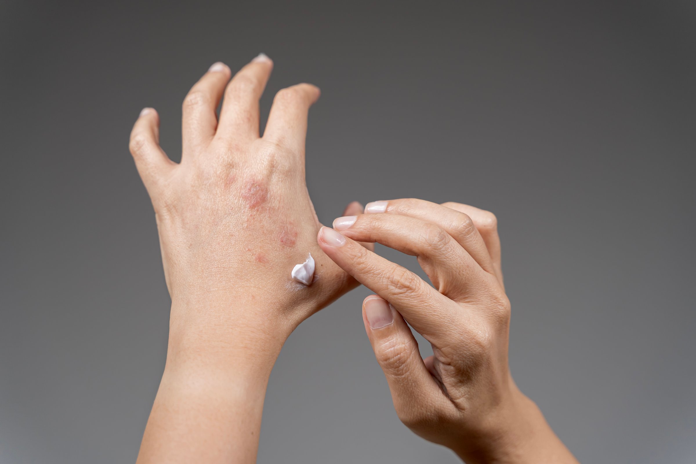 Applying cream woman's hand. Apply topical steroids, medical concept. Unrecognizable woman applying ointment or moisturizing cream in the treatment of eczema on hand, atopic dermatitis.