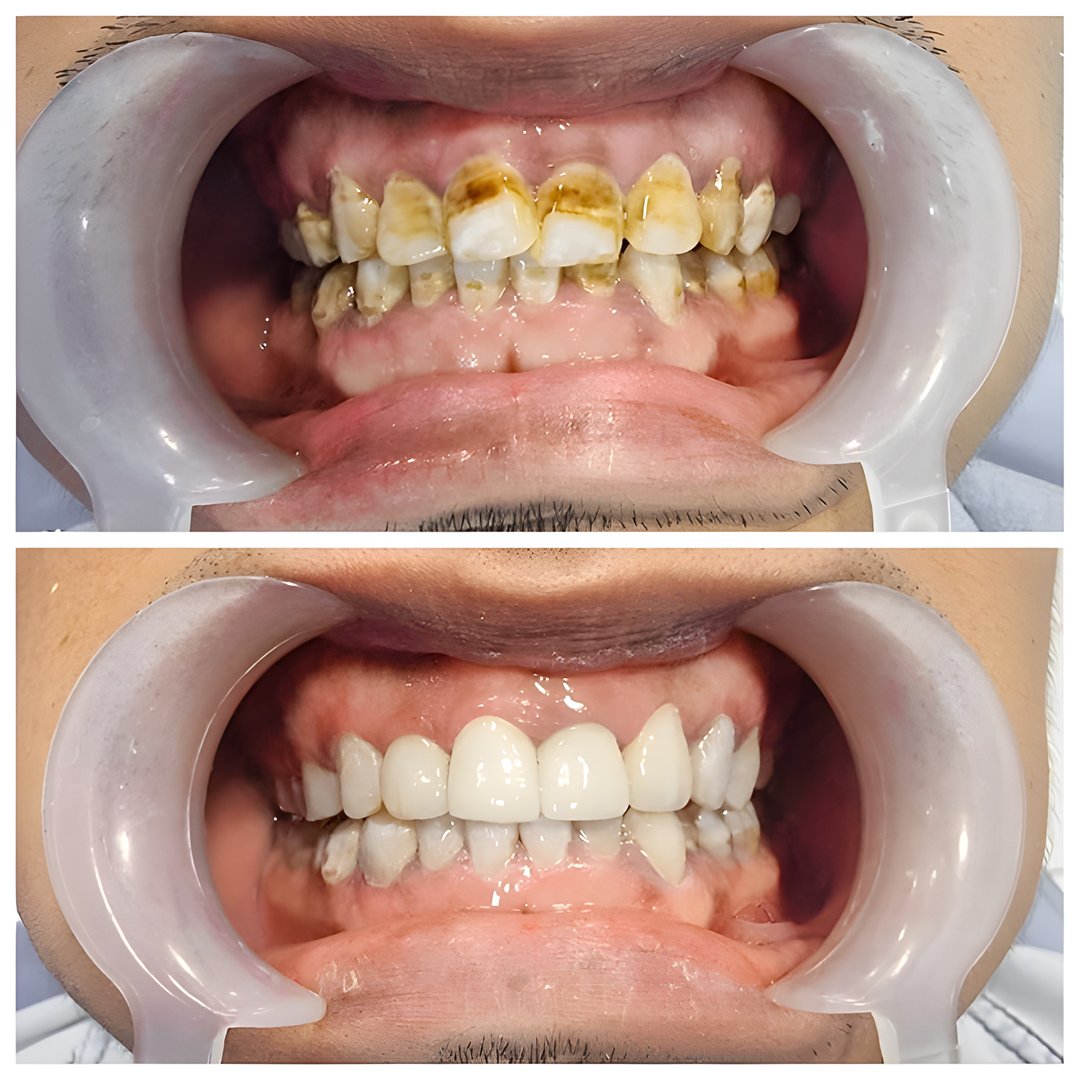 Before and after scaling and polishing treatment for tobacco stains on the teethi