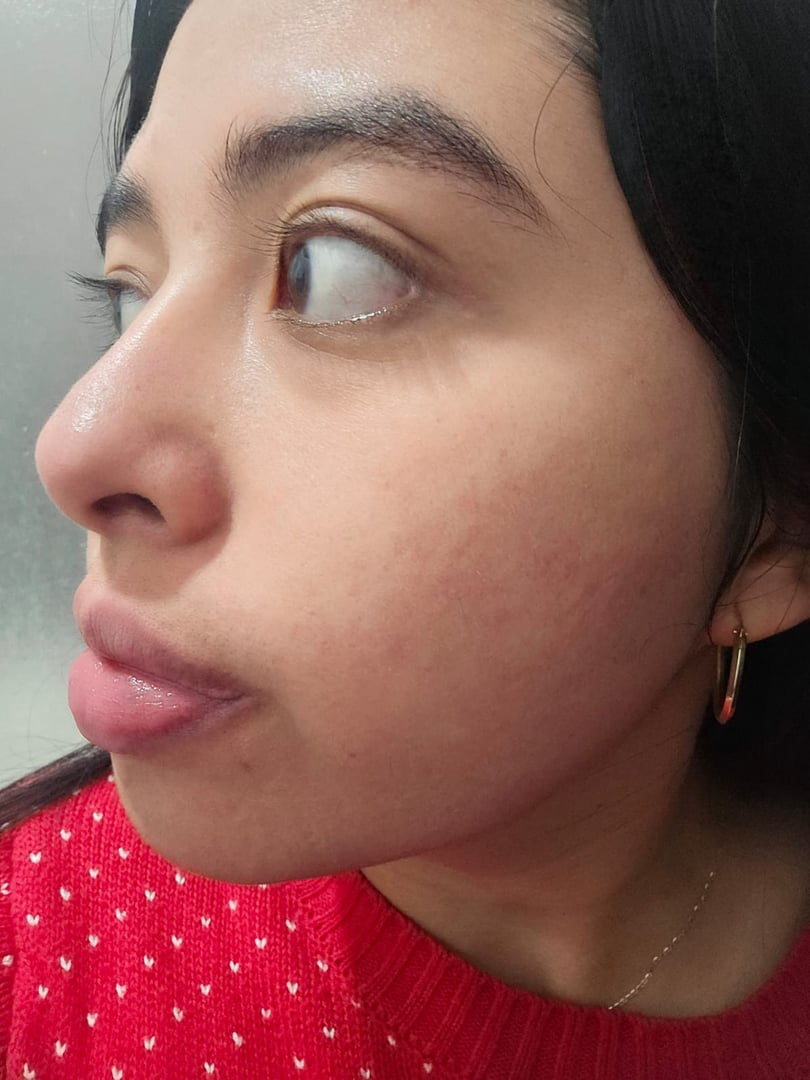 Después del tratamiento dermatológico