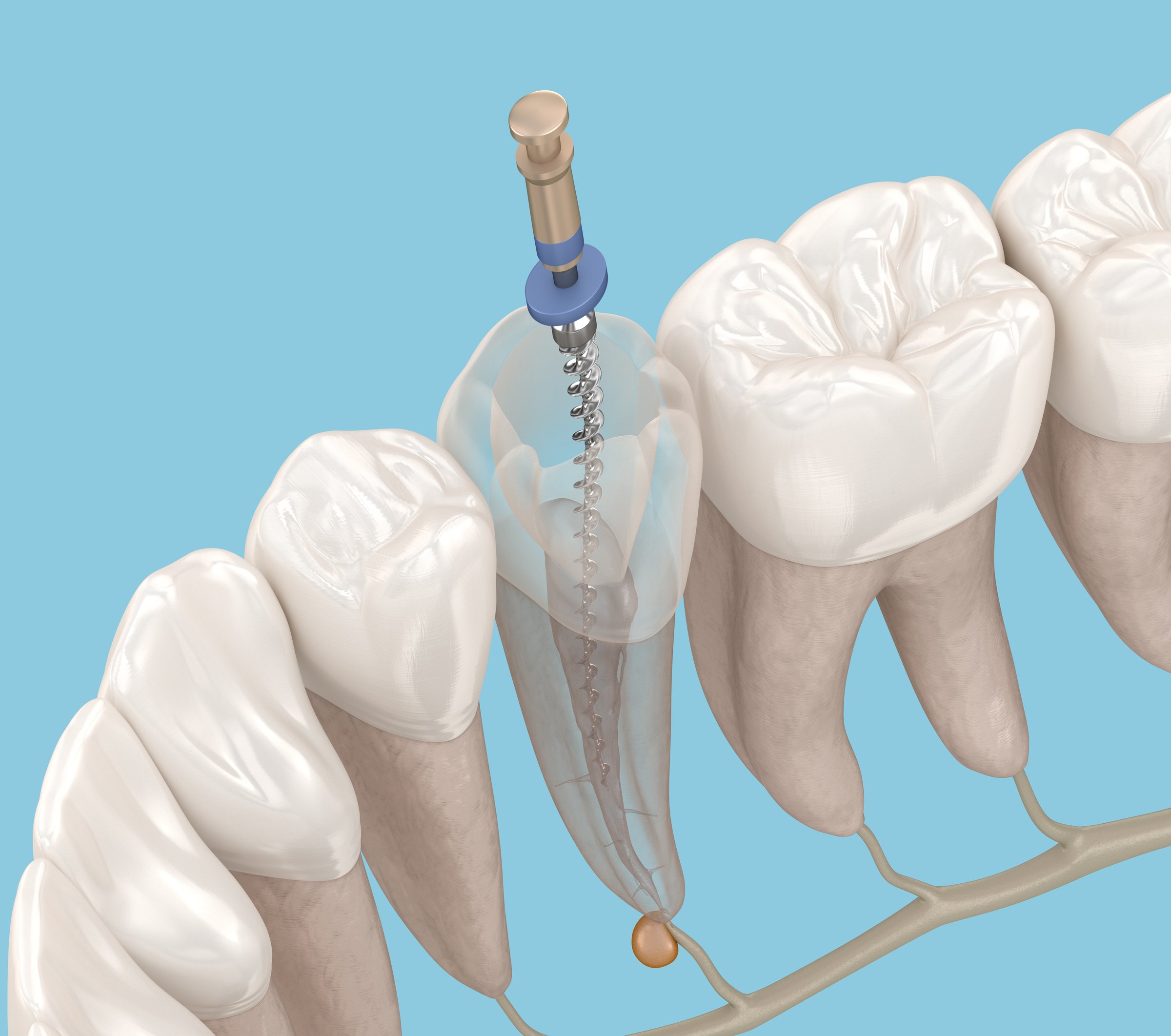 Endodontic root canal treatment process. Medically accurate tooth 3D illustration.
