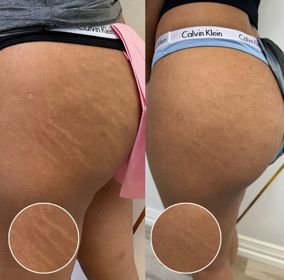 Stretch marks before and after treatment
