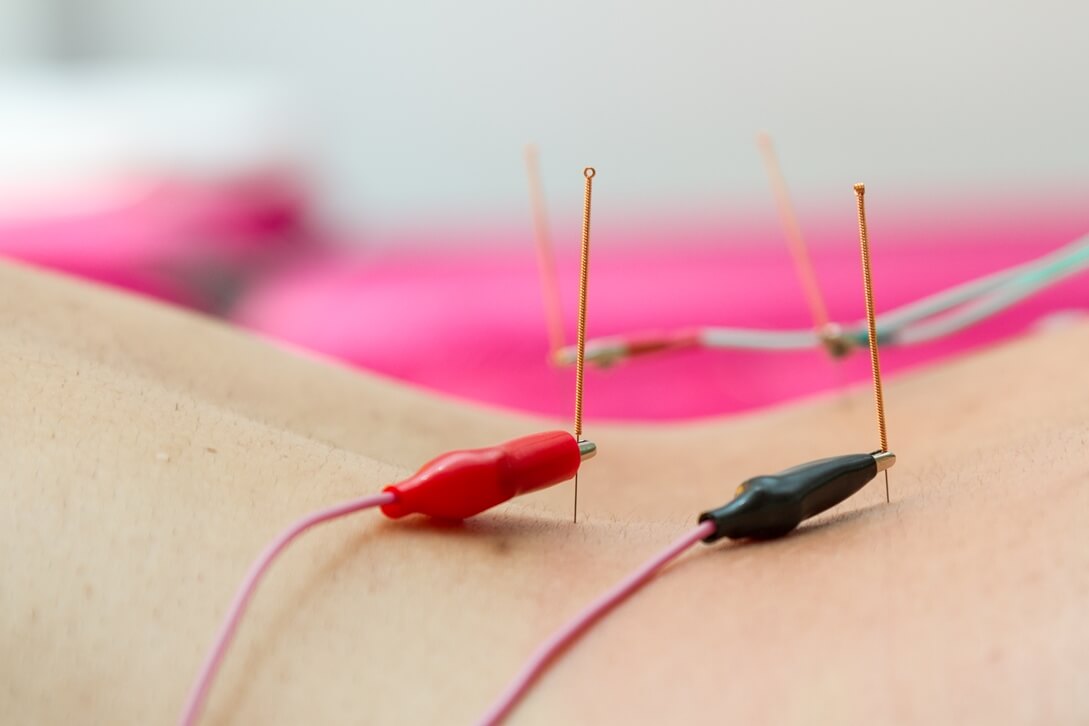 Electro-acupuncture chiropractic treatment