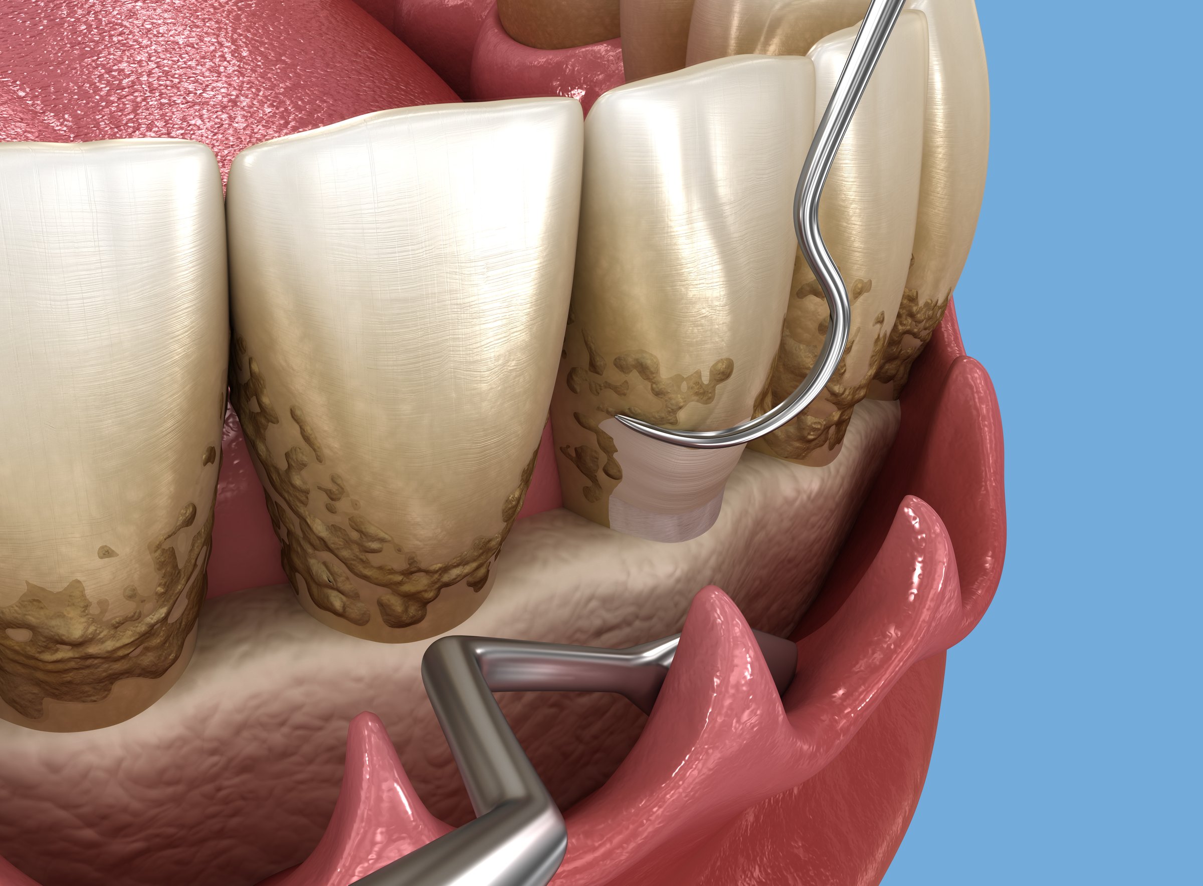 Open curettage: Scaling and root planing (conventional periodontal therapy). Dental 3D illustration