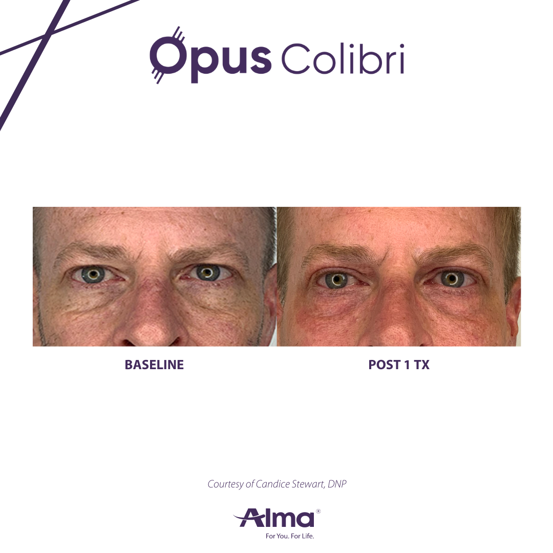 OPUS Colibri MesmerEyes before and after treatment results