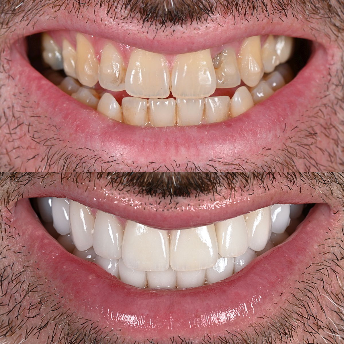 Veneer transformation before and after