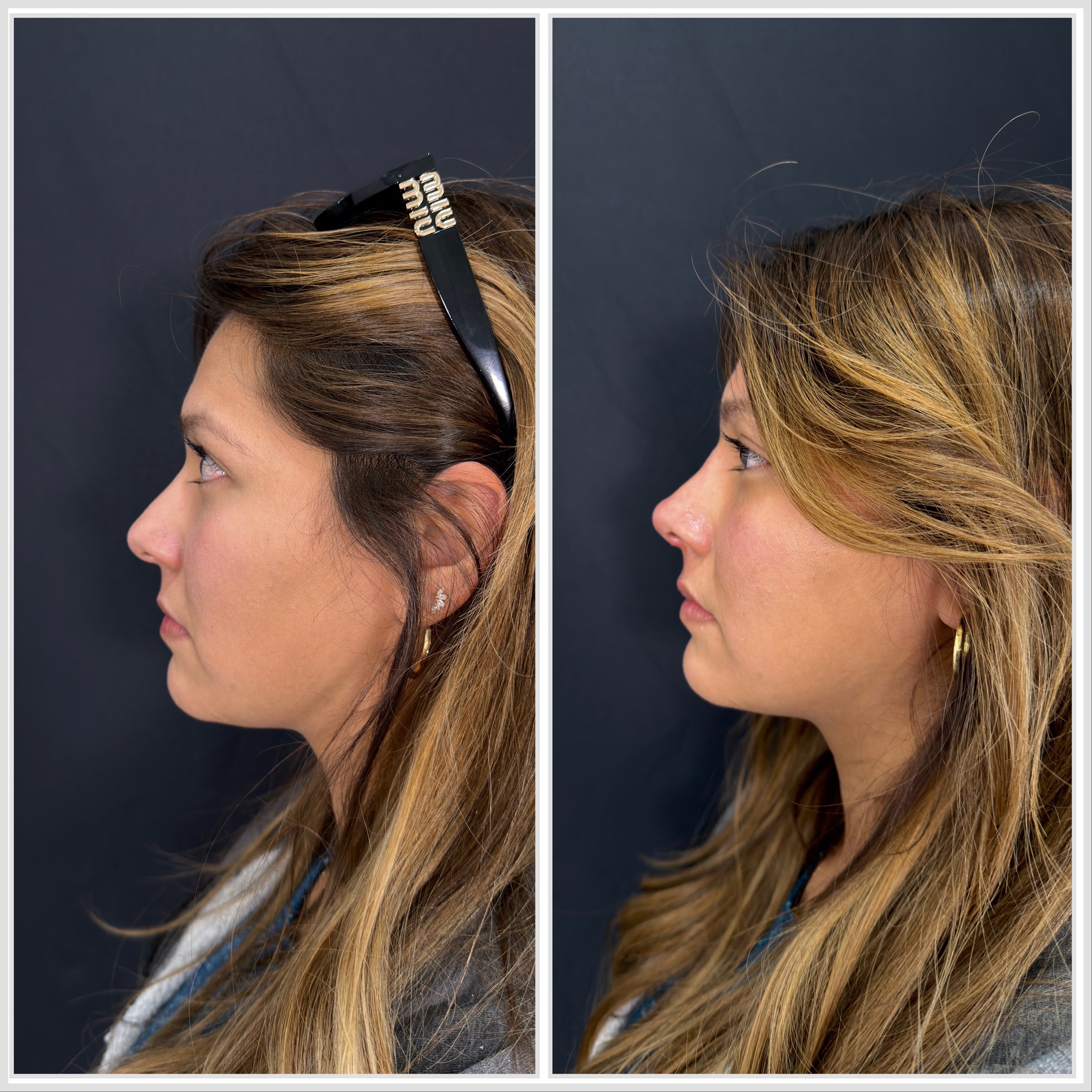 Antes y después - Rinomodelación