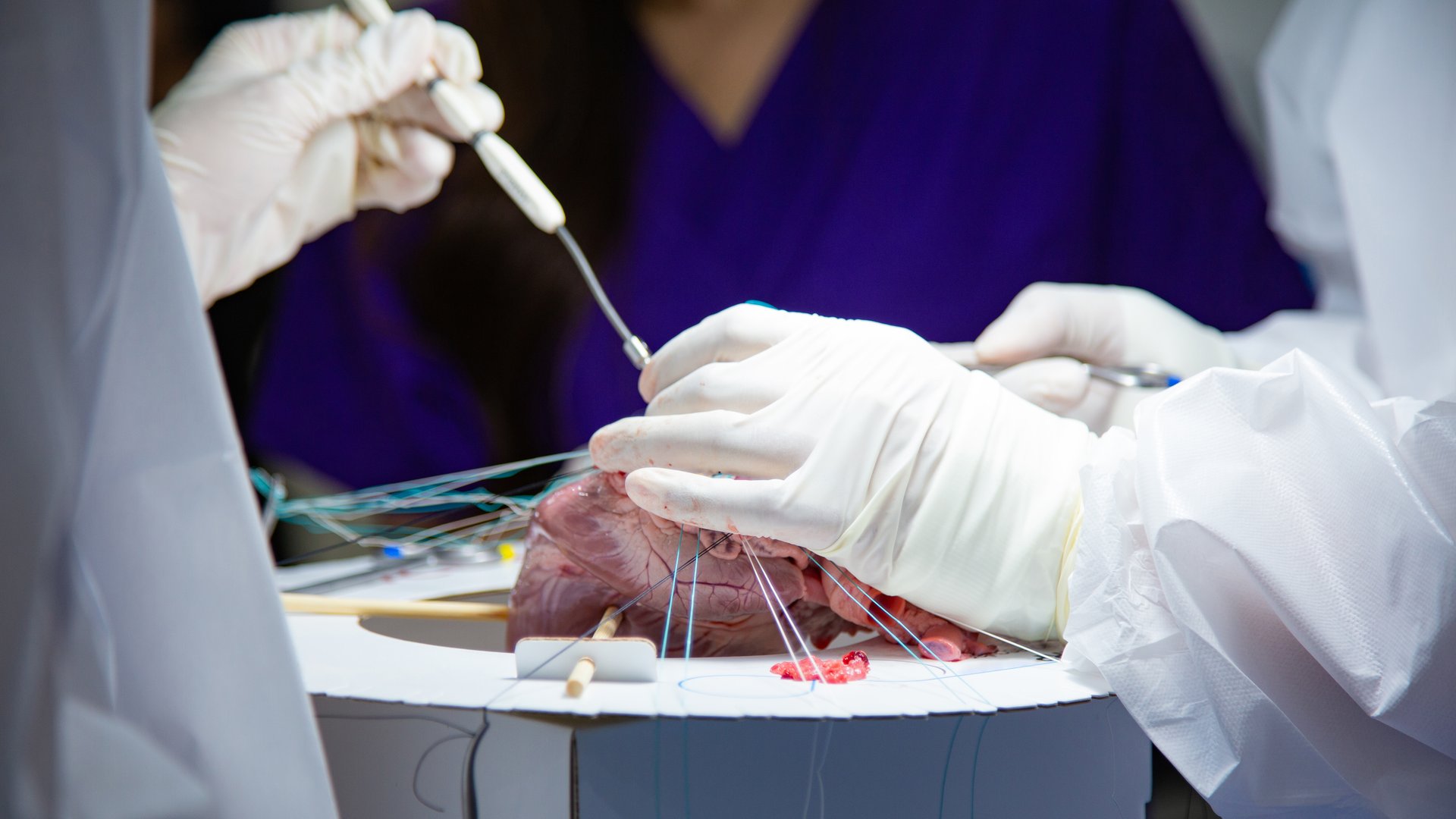 A team of surgeons are practicing artificial heart valve replacement surgery. Sutures are placed through the annulus and through the aortic prosthesis and tied. Concept of medical science and surgery.