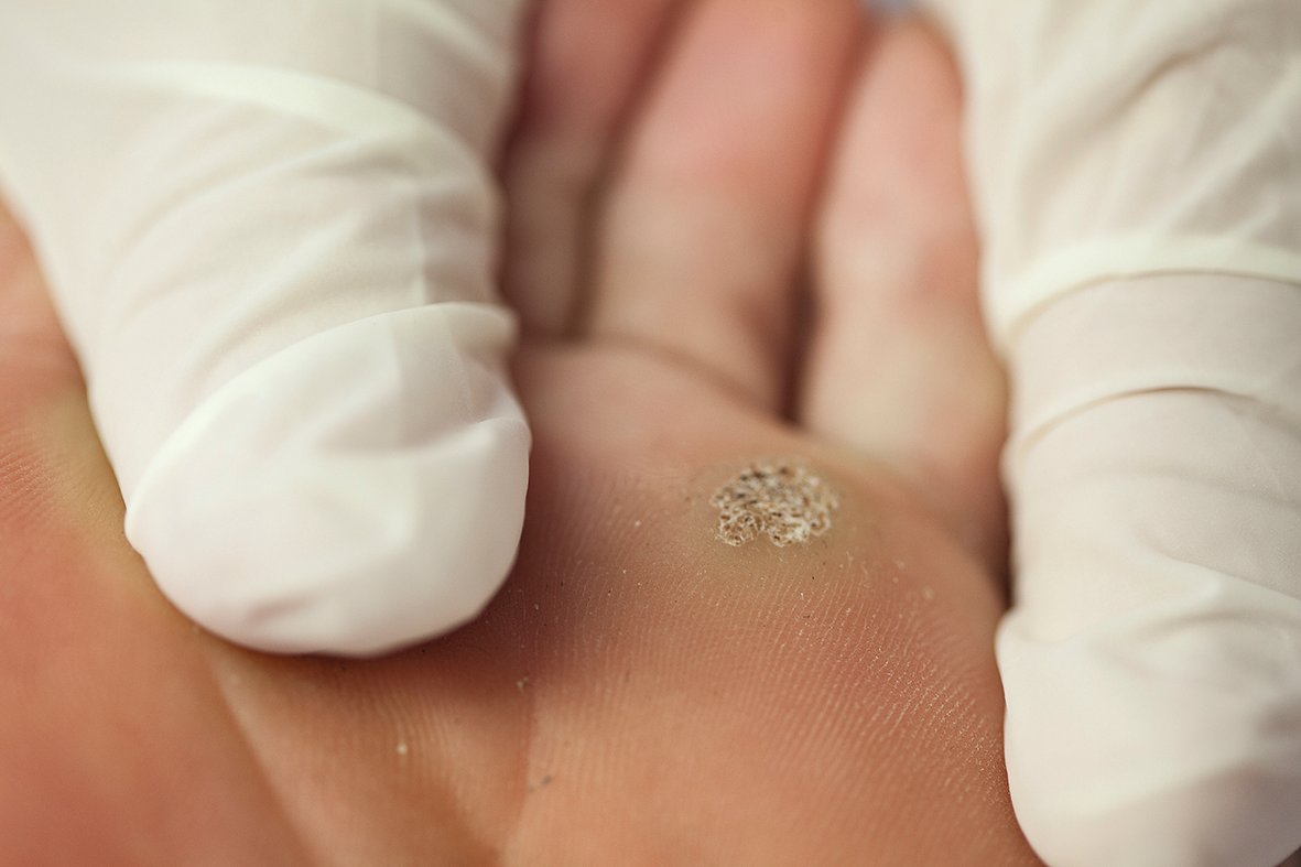 Kompliceret fodbehandling