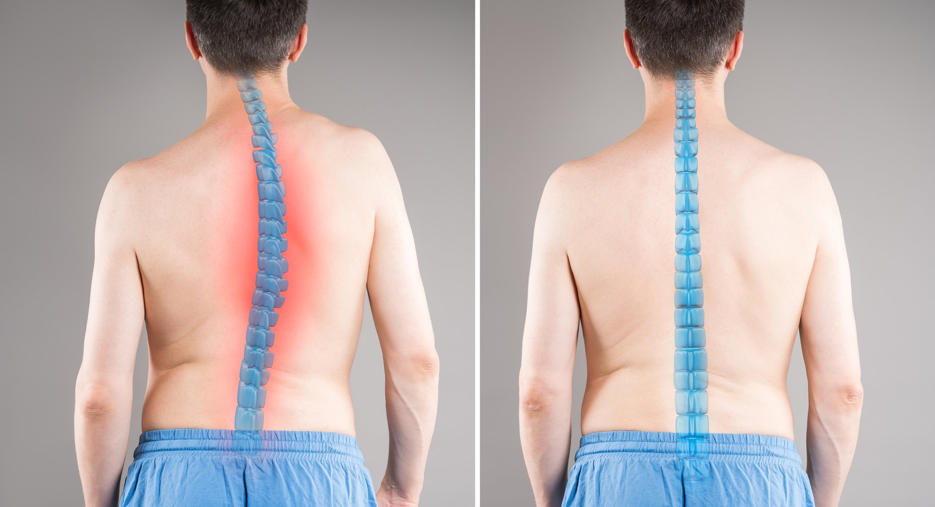 Man before and after spine curvature correction, scoliosis treatment comparison, gray background