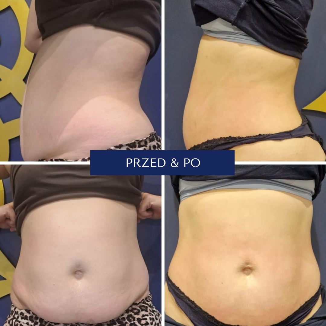 Magnifico efekty przed i po zabiegu 4