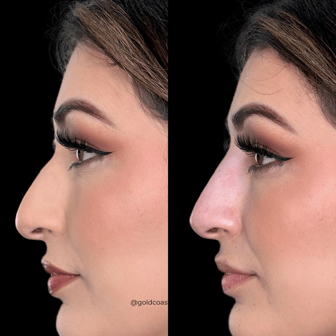 Nasal profile enhancement