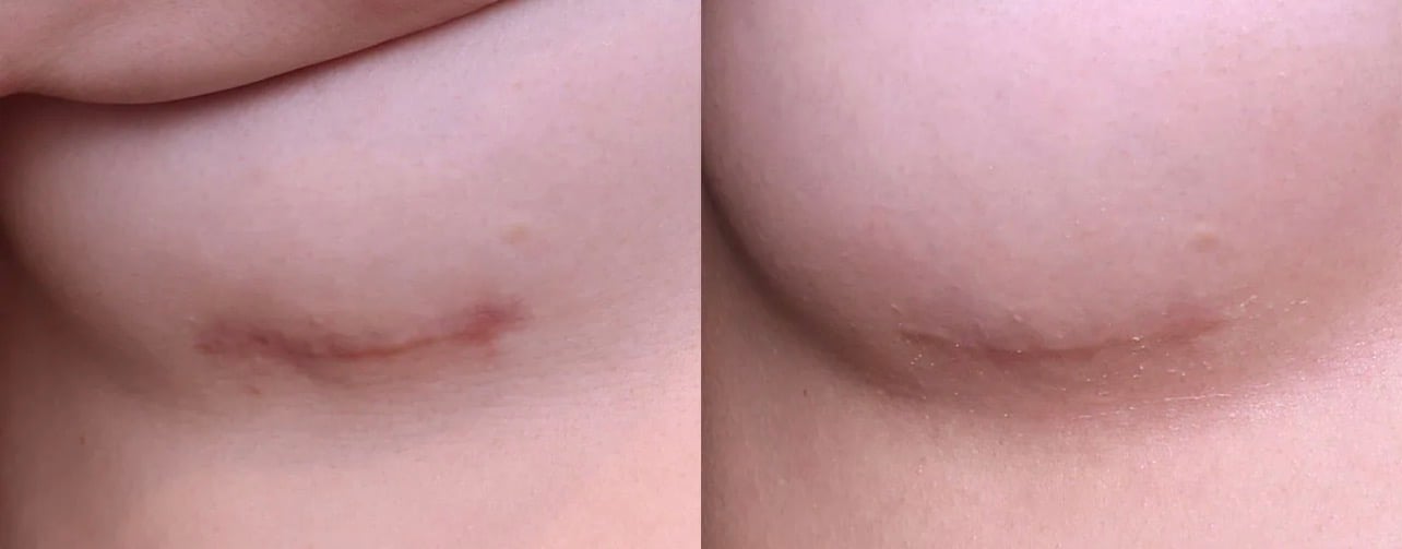 Before and after breast restoration scar camouflage result