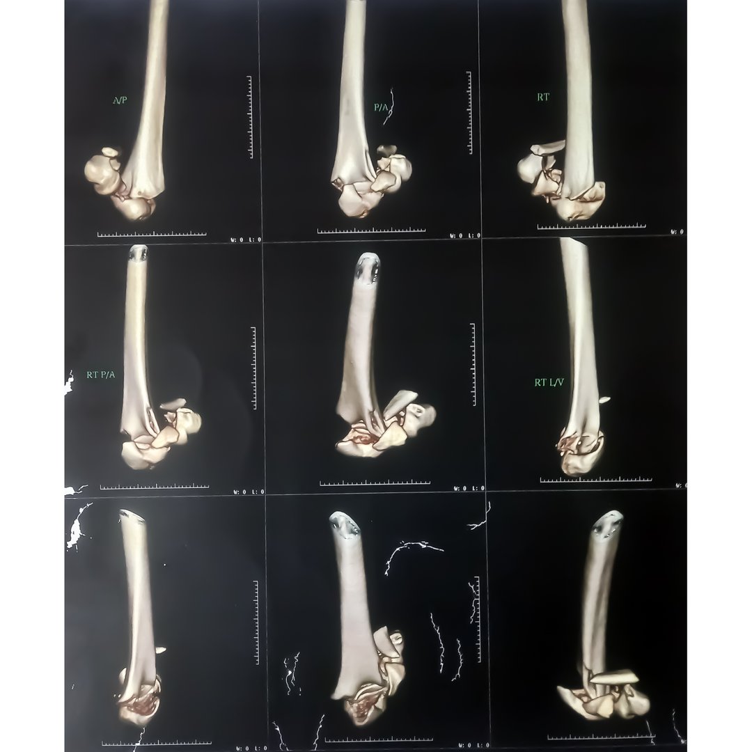 CT scan 3D image of an elbow joint showing dislocation and fracture after an accident female patient