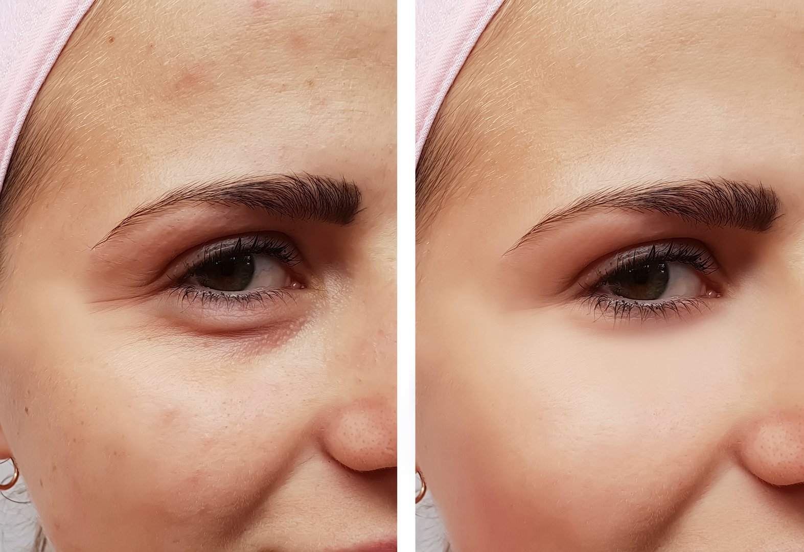 beautiful girl face wrinkles before and after procedures