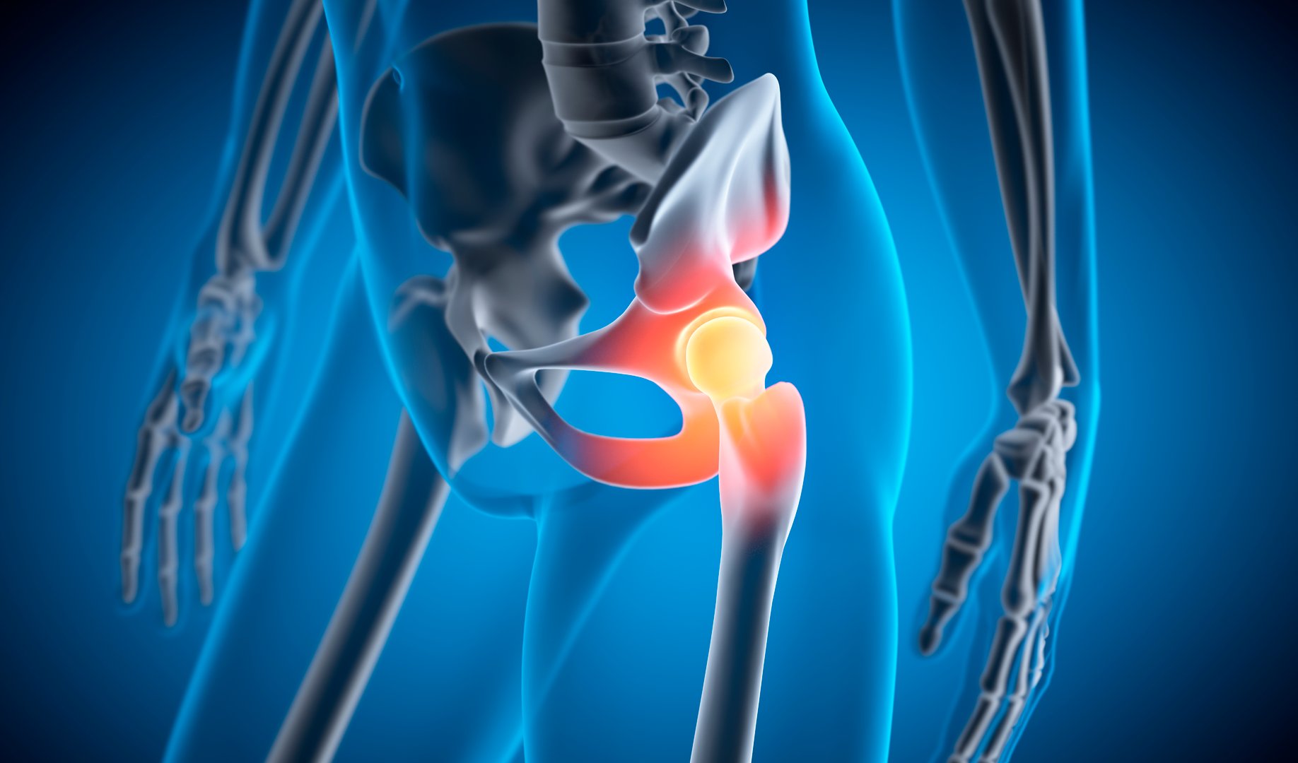 Medical X Ray 3D illustration of a painful hip joint