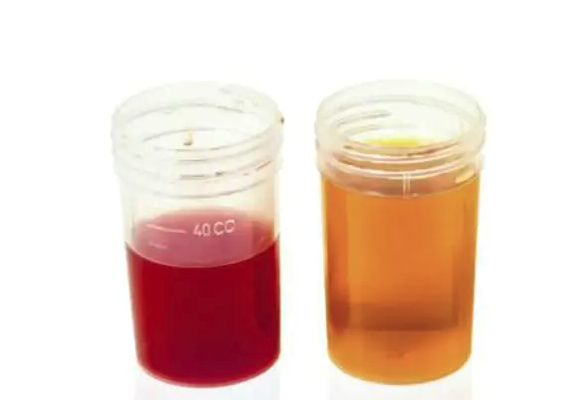 Tiểu ra máu và các loại đái máu