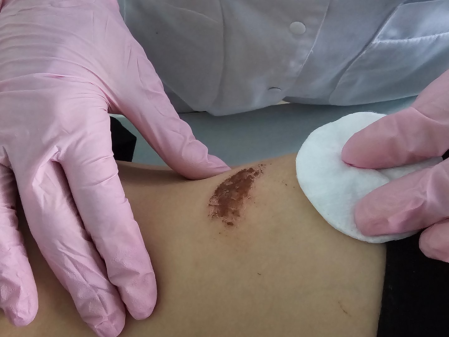 Medical professional cleaning a wound on a patient's arm using sterile pads in a clinical setting