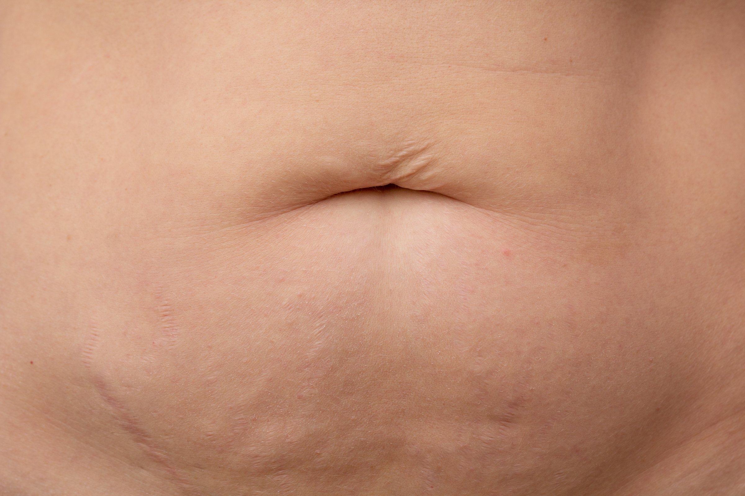 Professional Mommy Makeover Surgical Result