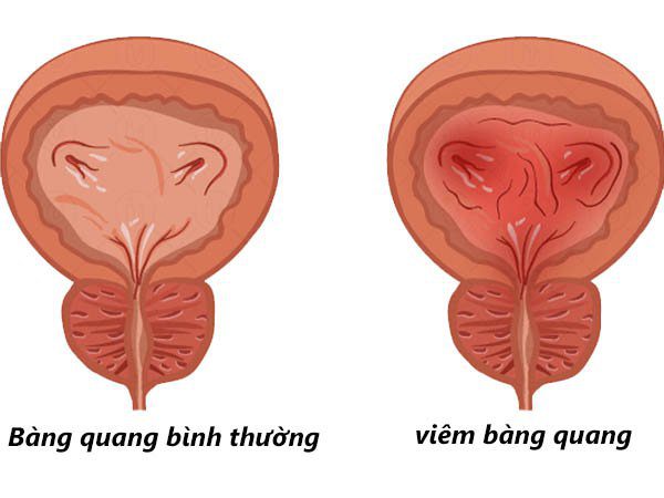 Viêm bàng quang