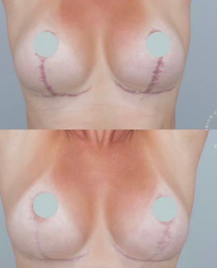 Before and after breast restoration scar camouflage result