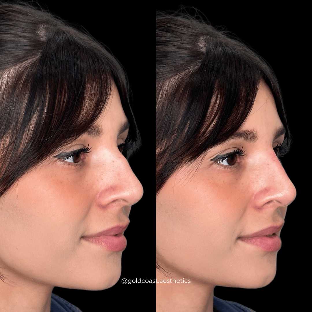 Nasal contouring results