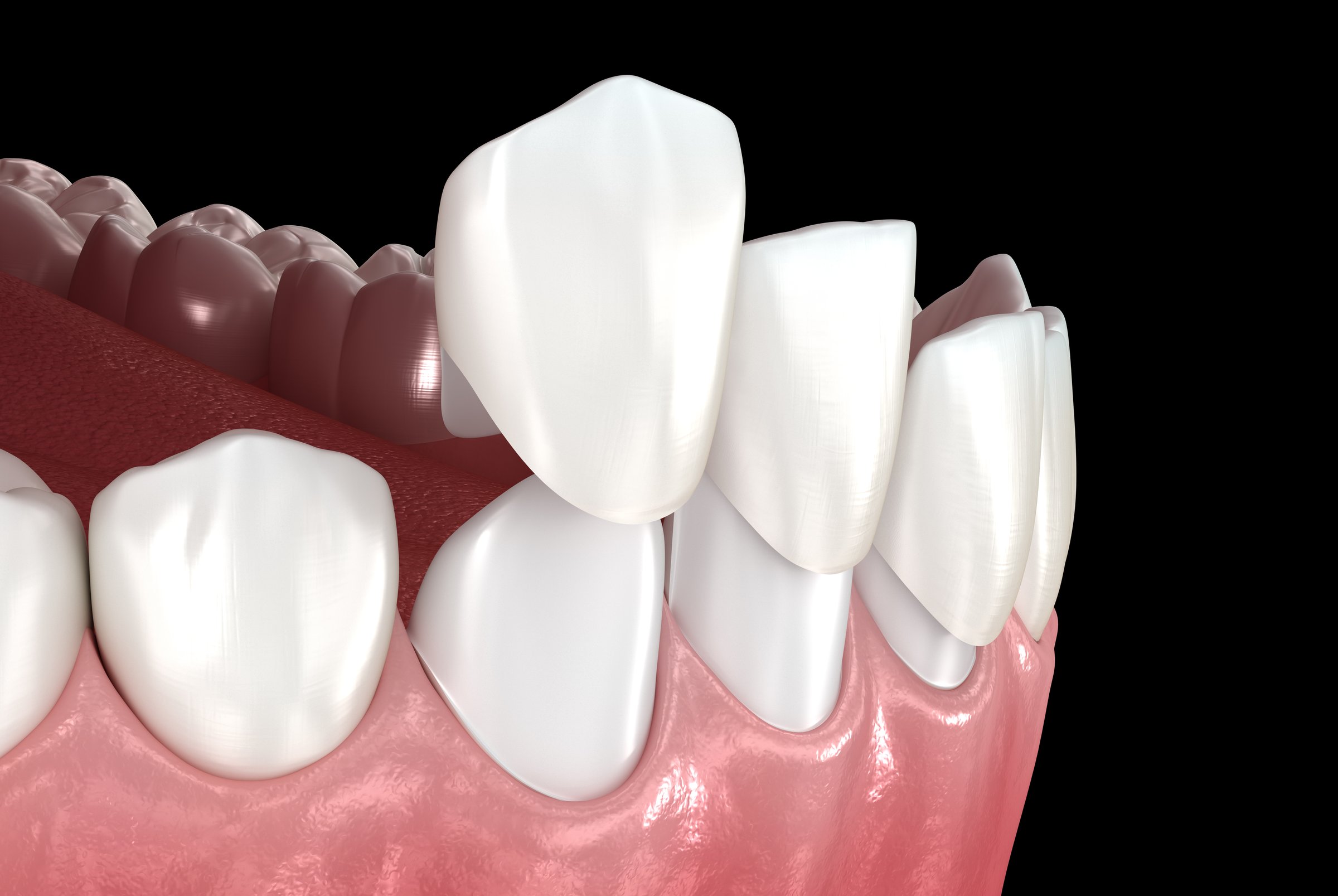 Dental veneer placement over frontal teeth. 3D illustration