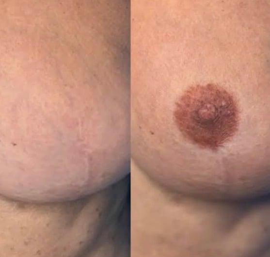 Before and after breast restoration scar camouflage result