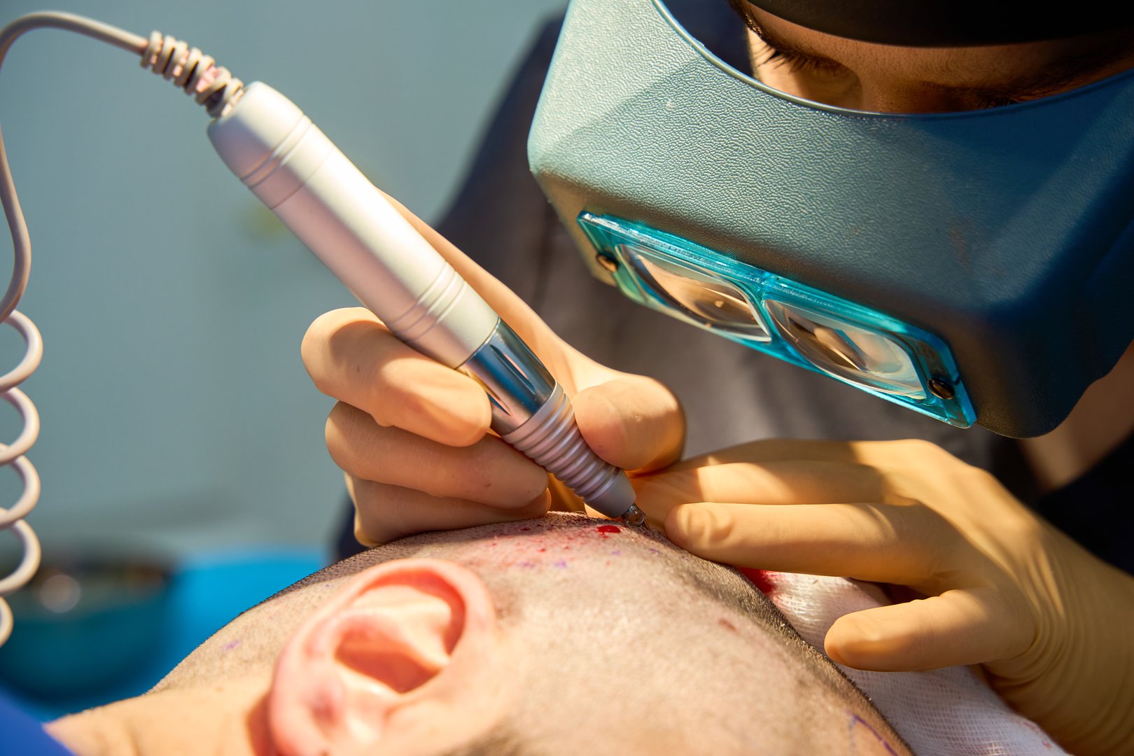 close up of a doctor extracting follicles for hair grafting
