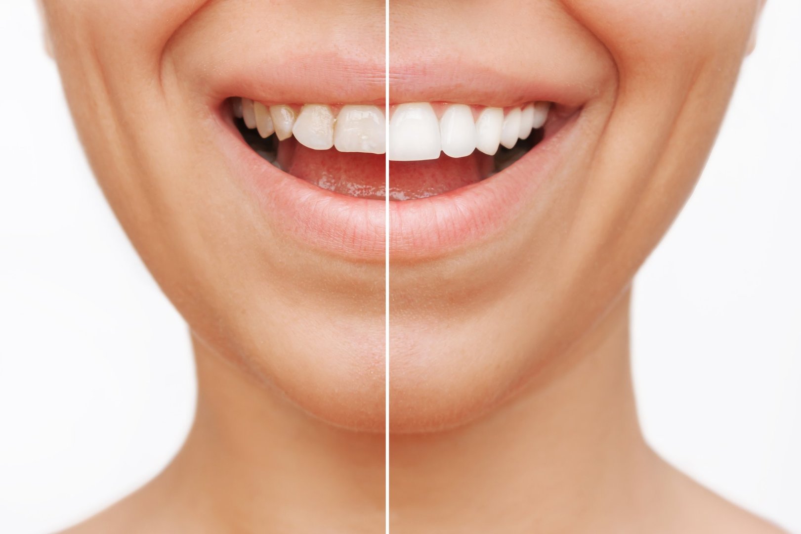 Blanqueamiento Dental