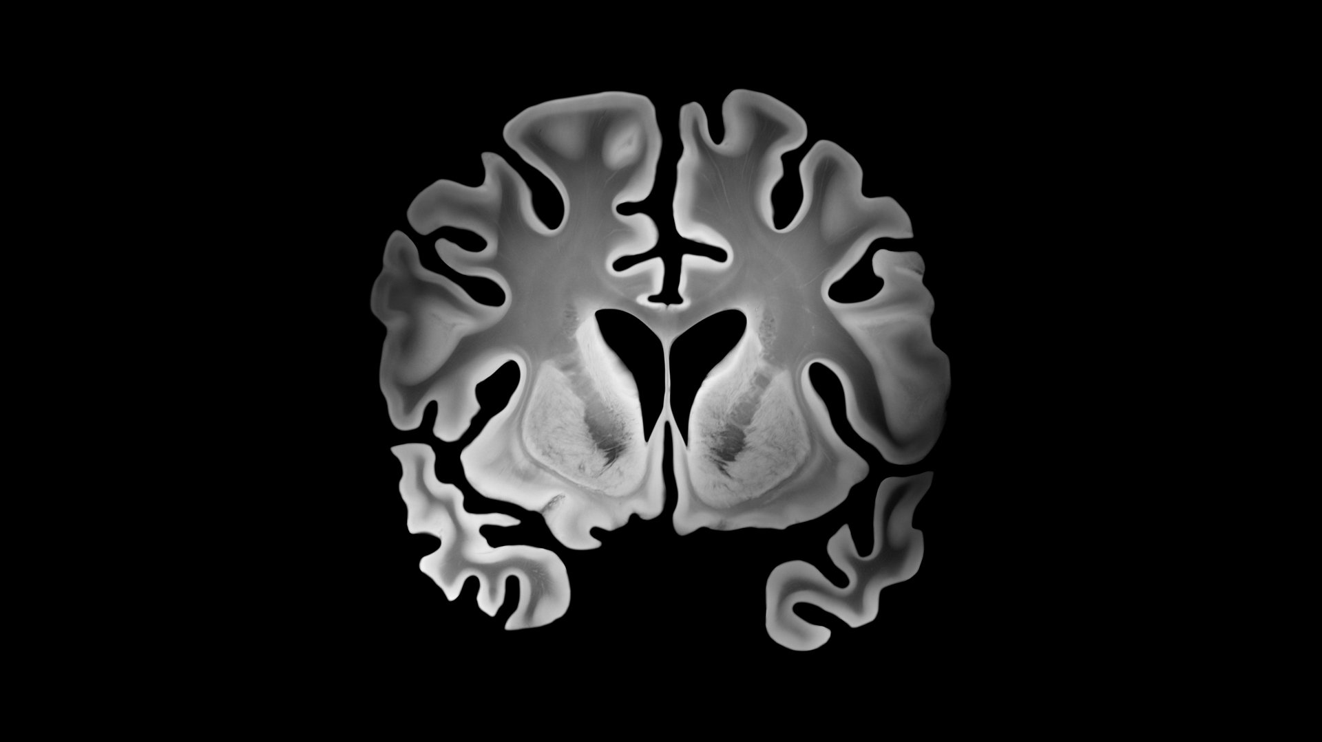 Alzheimer bilateral coronal brain slice with cortical thinning widened sulci enlarged ventricles and medial temporal lobe atrophy affecting both hemispheres