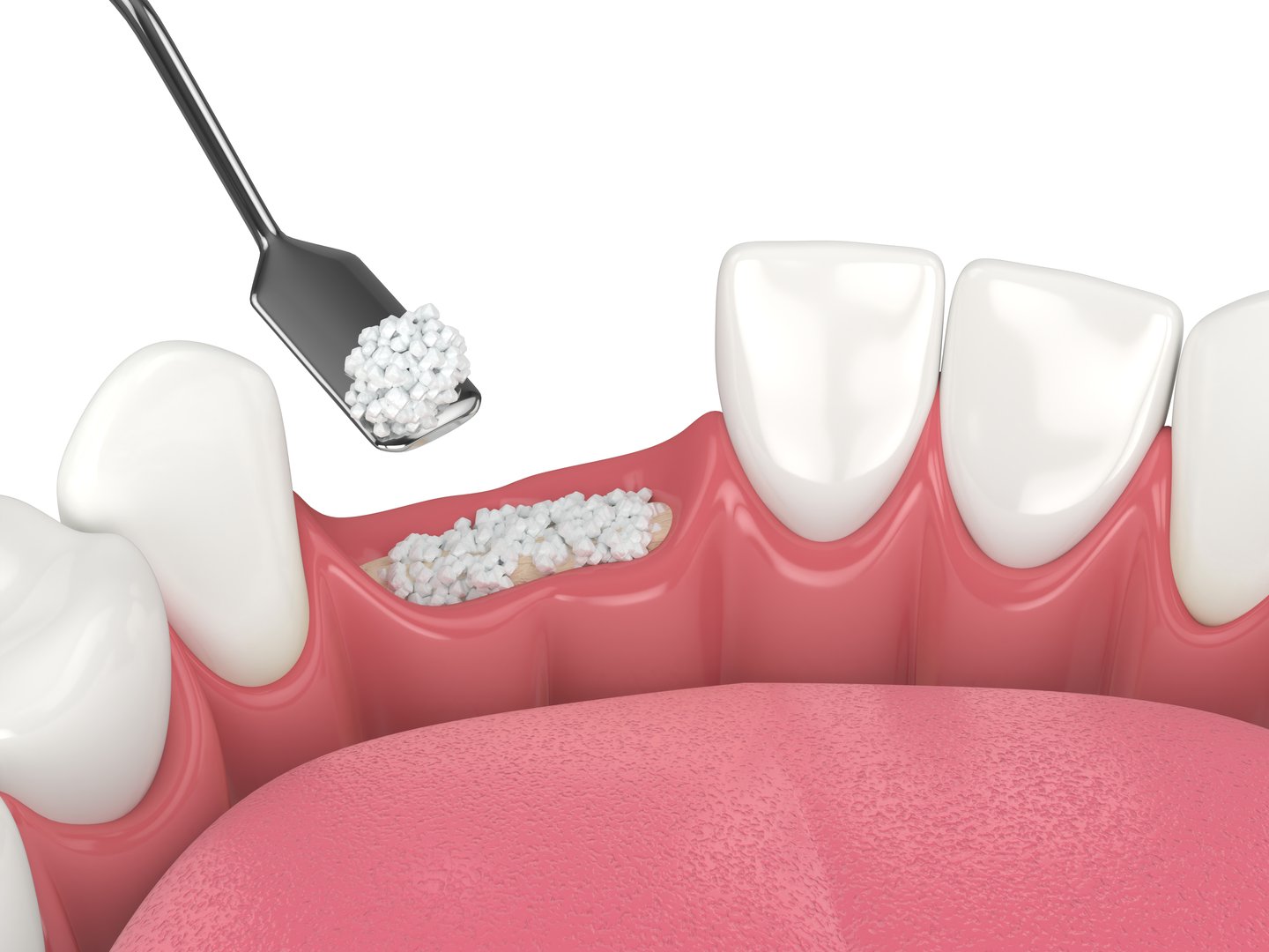 Bone grafting for dental implants explained by a Murwillumbah dentist