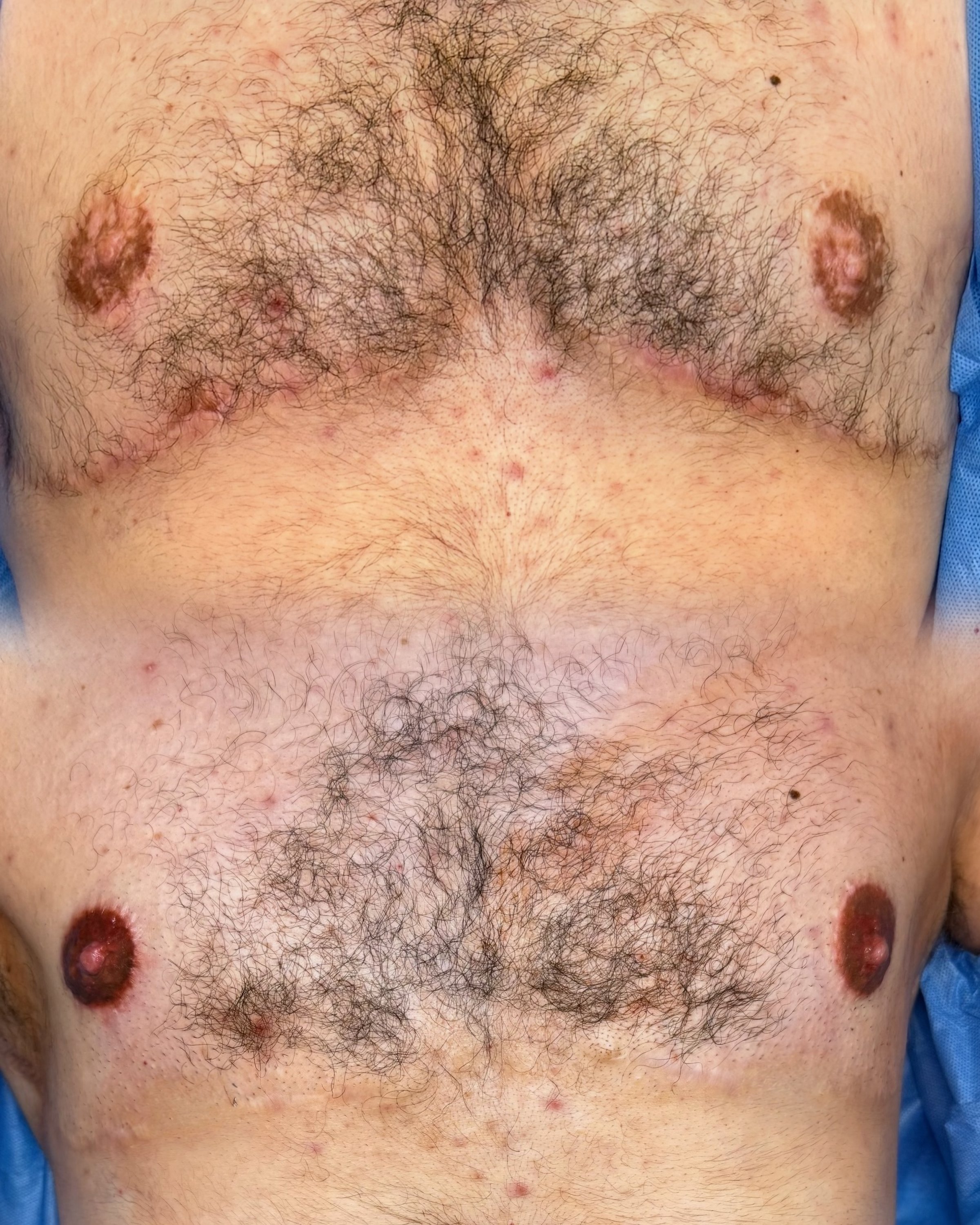 Before and after breast restoration scar camouflage result