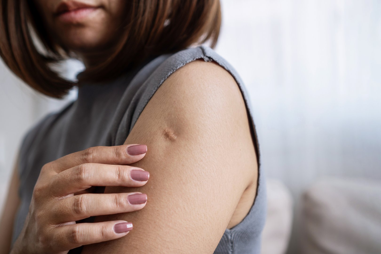 closeup monkeypox and smallpox vaccine scar on woman's arm