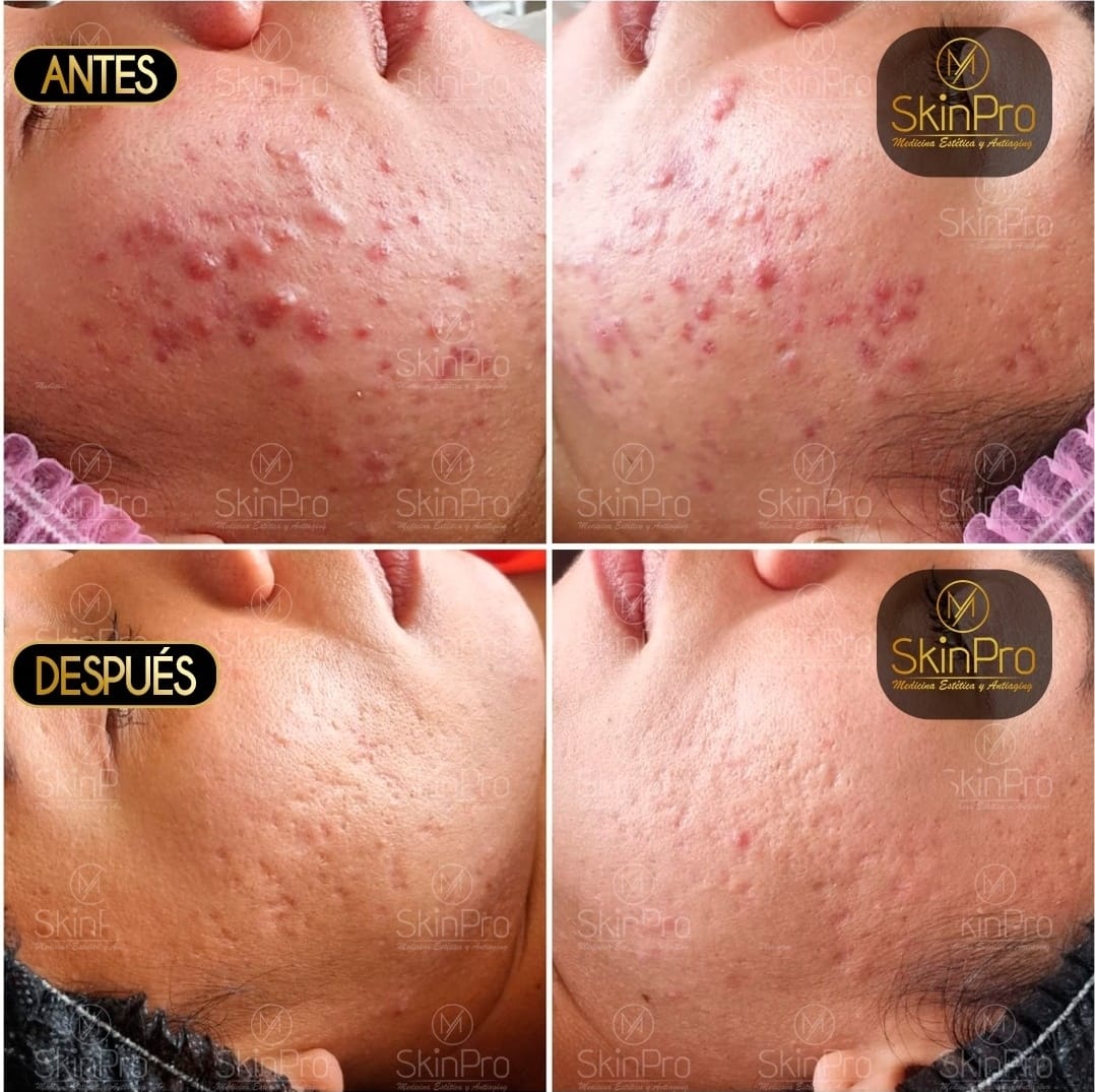 Resultado del tratamiento