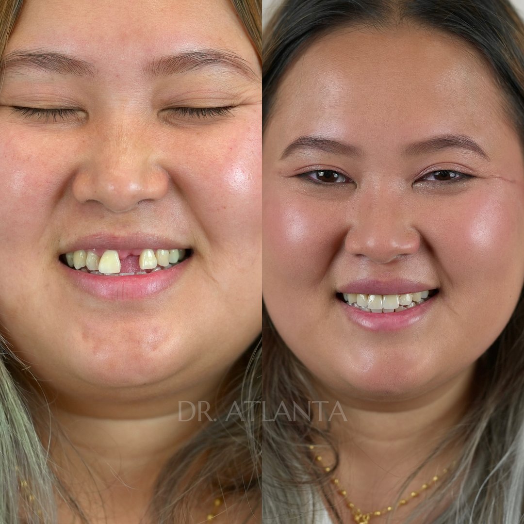 Before and after veneers transformation