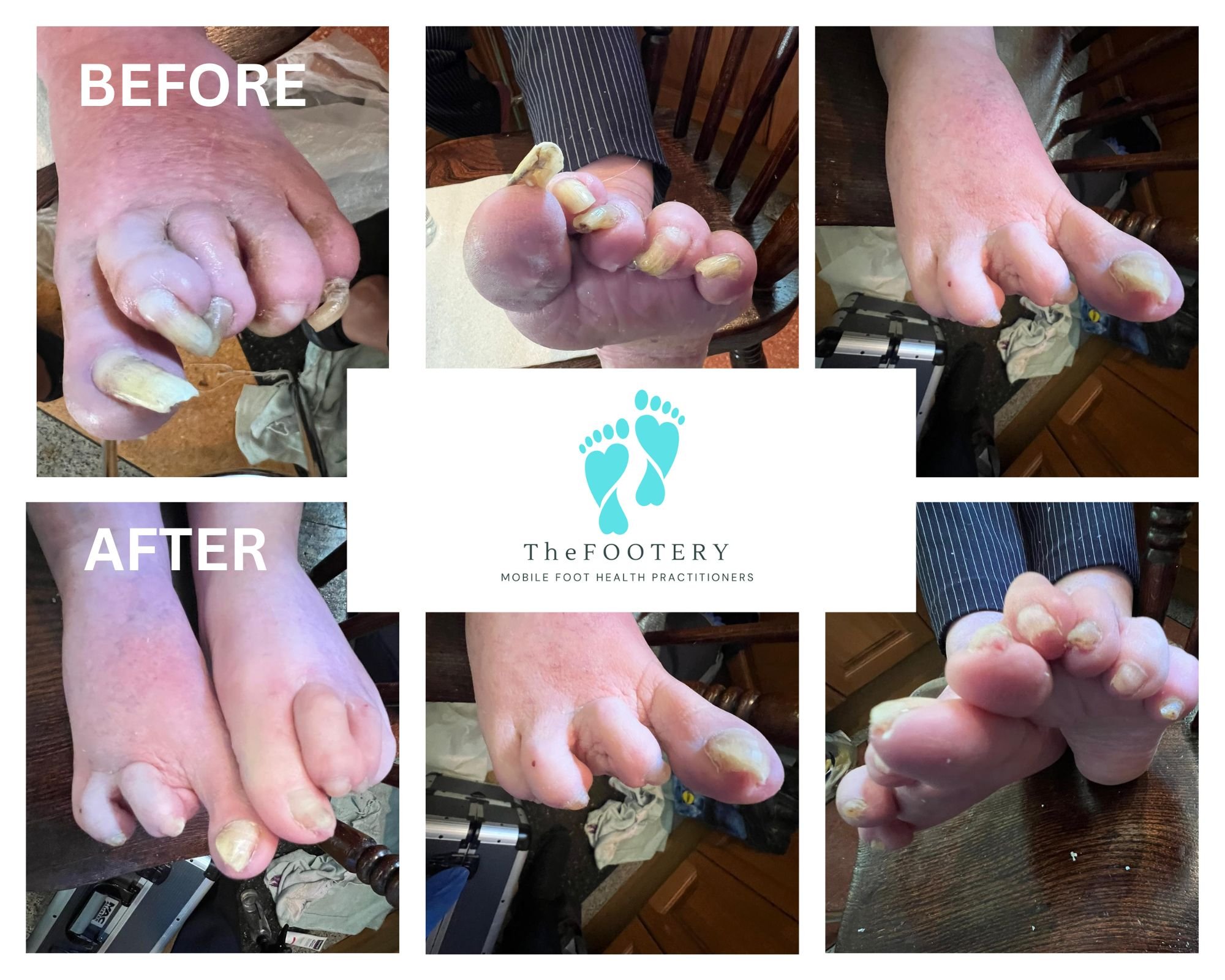 Before and after images of foot treatment showing improvement in toenail health and appearance.