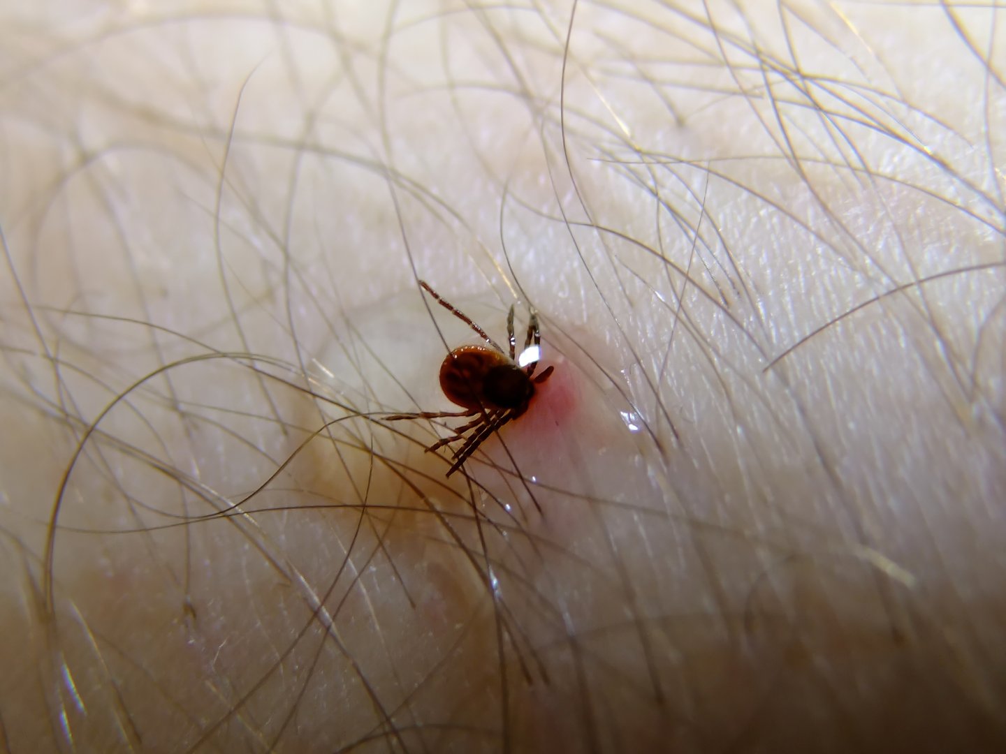 Tick embedded in skin
