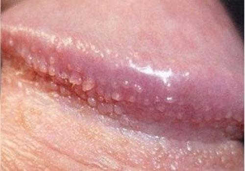 Dấu hiệu nhận biết hạt ngọc dương vật