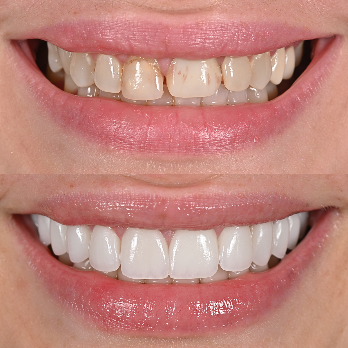Sarah R veneer transformation before and after