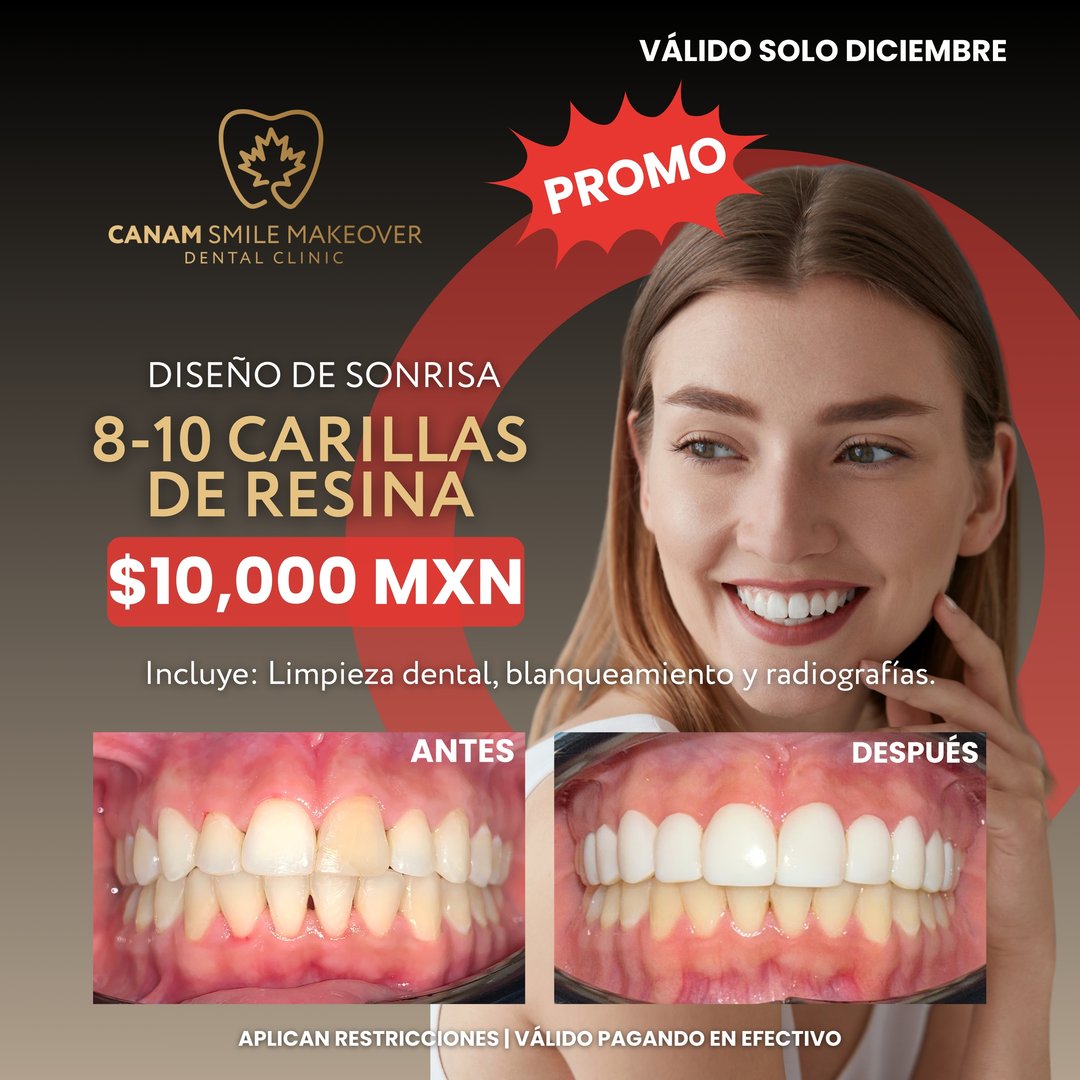 Promoción dental Canam Smile Makeover