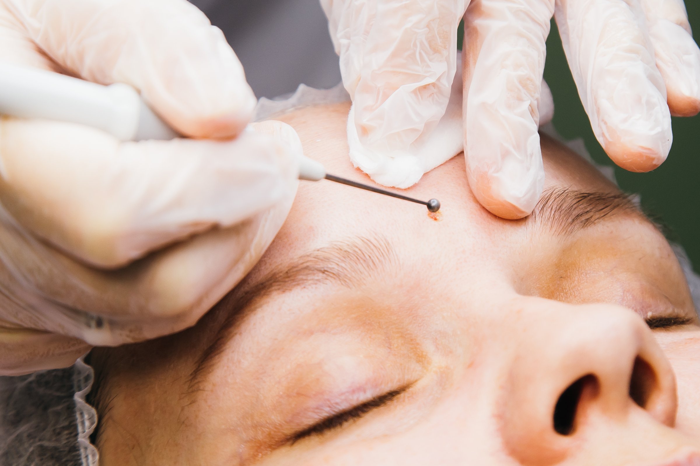 Removal of birthmark from female face. Dermatologist surgeon using a professional electrocautery for removing mole. Comparison of results before and after operation.