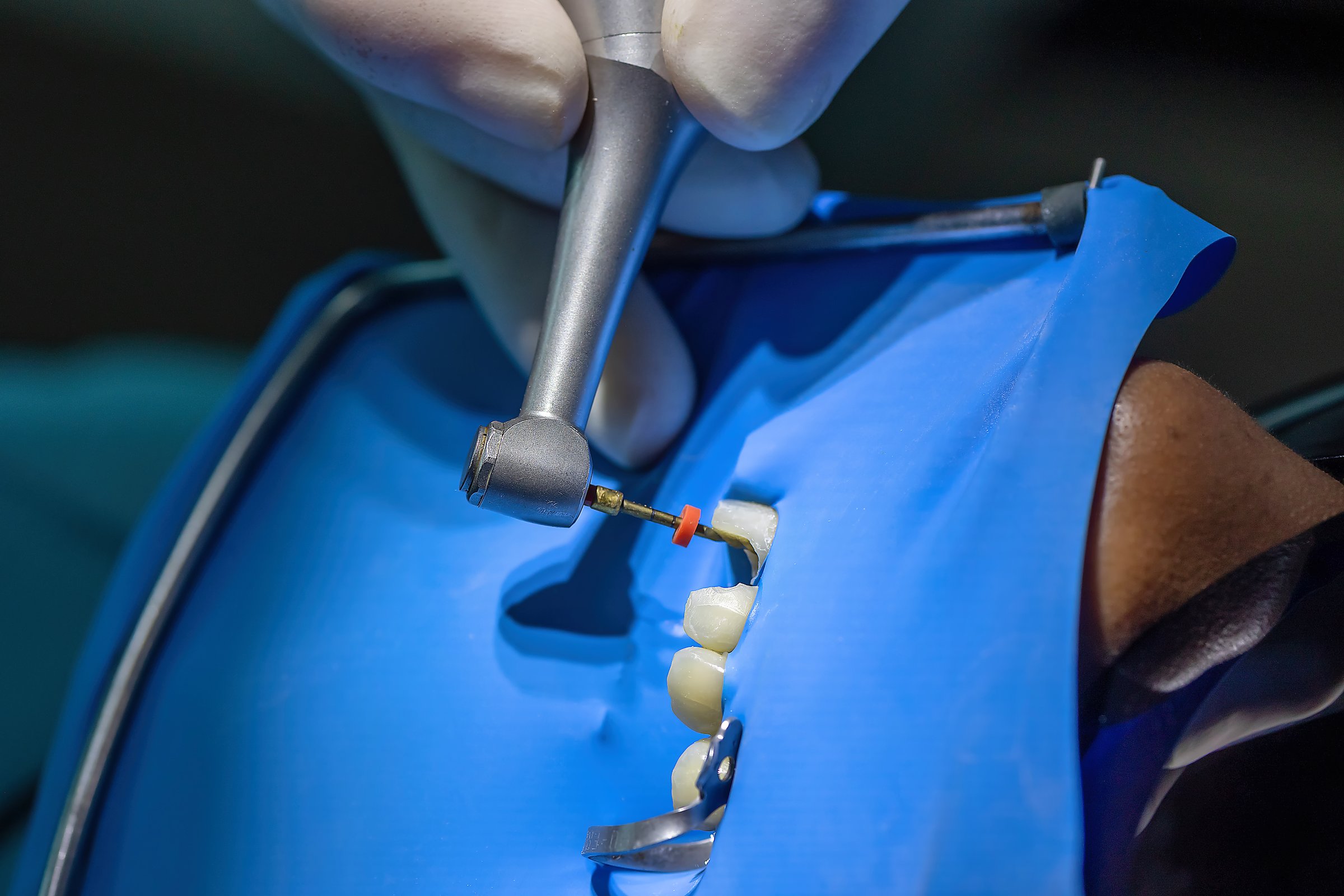 Dental handpiece with rotary file inserted into a tooth during root canal treatment under rubber dam isolation. Concept of endodontics, precision work, and patient care.